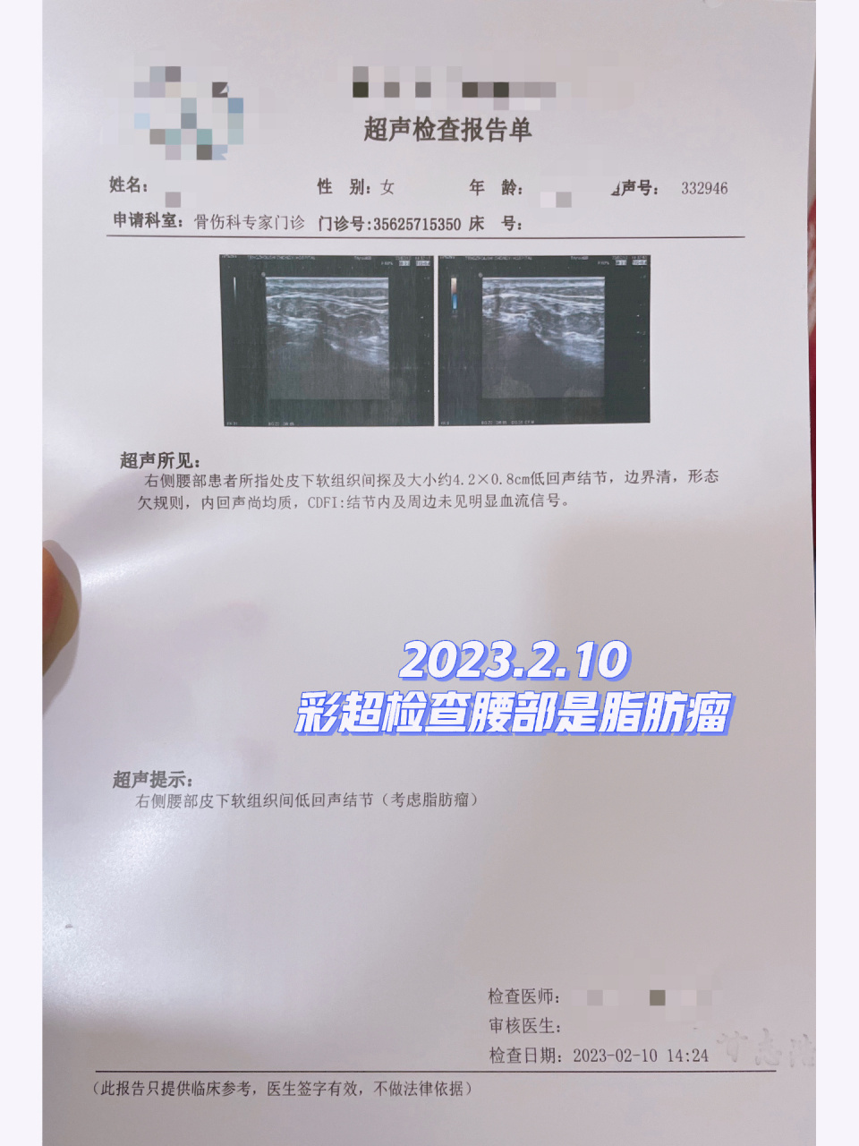 脂肪瘤切除手术01 2023.2.