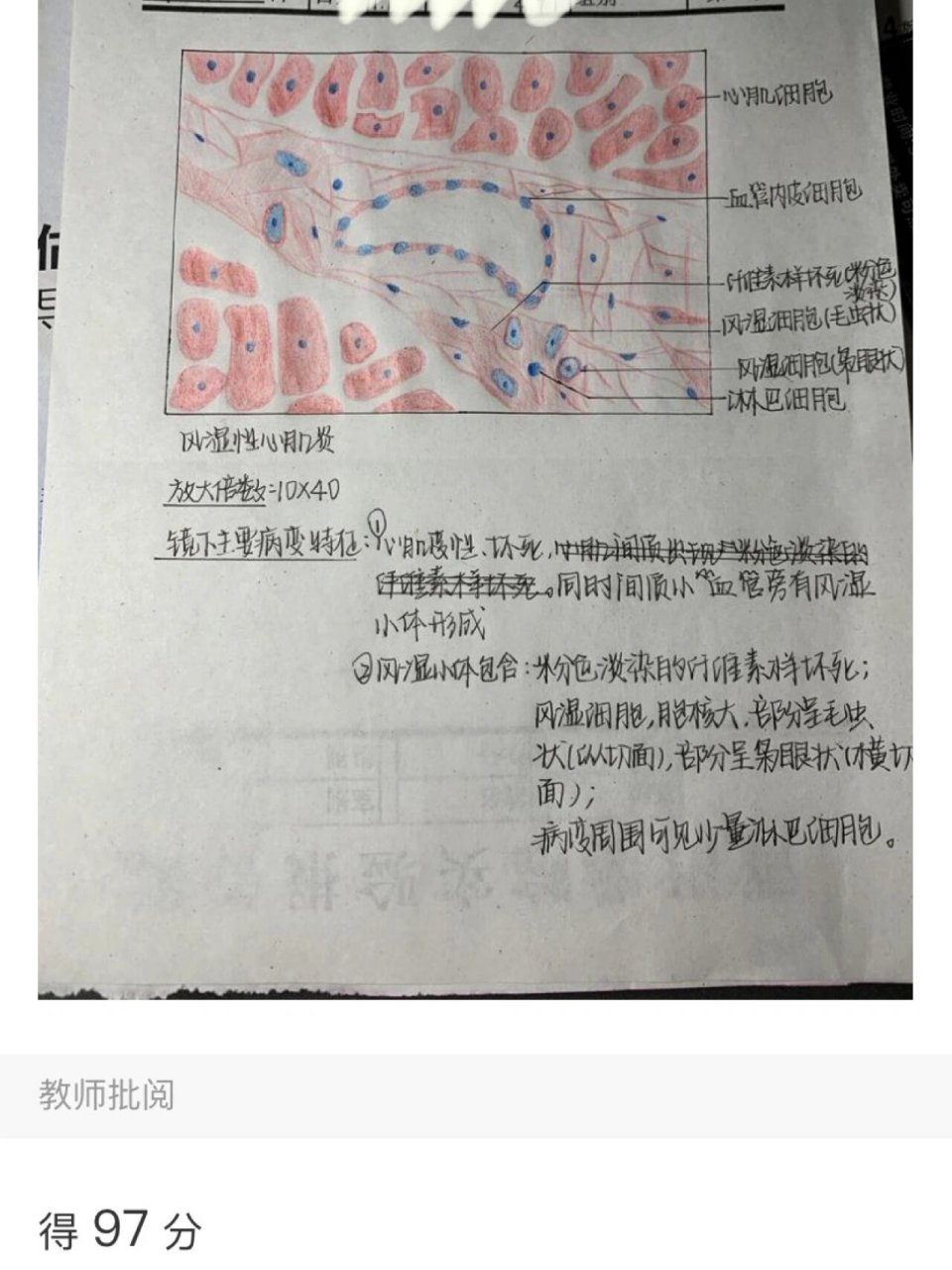 【病理学】红蓝铅笔图 鳞状上皮细胞癌和风湿性心肌炎的病理切片 一个