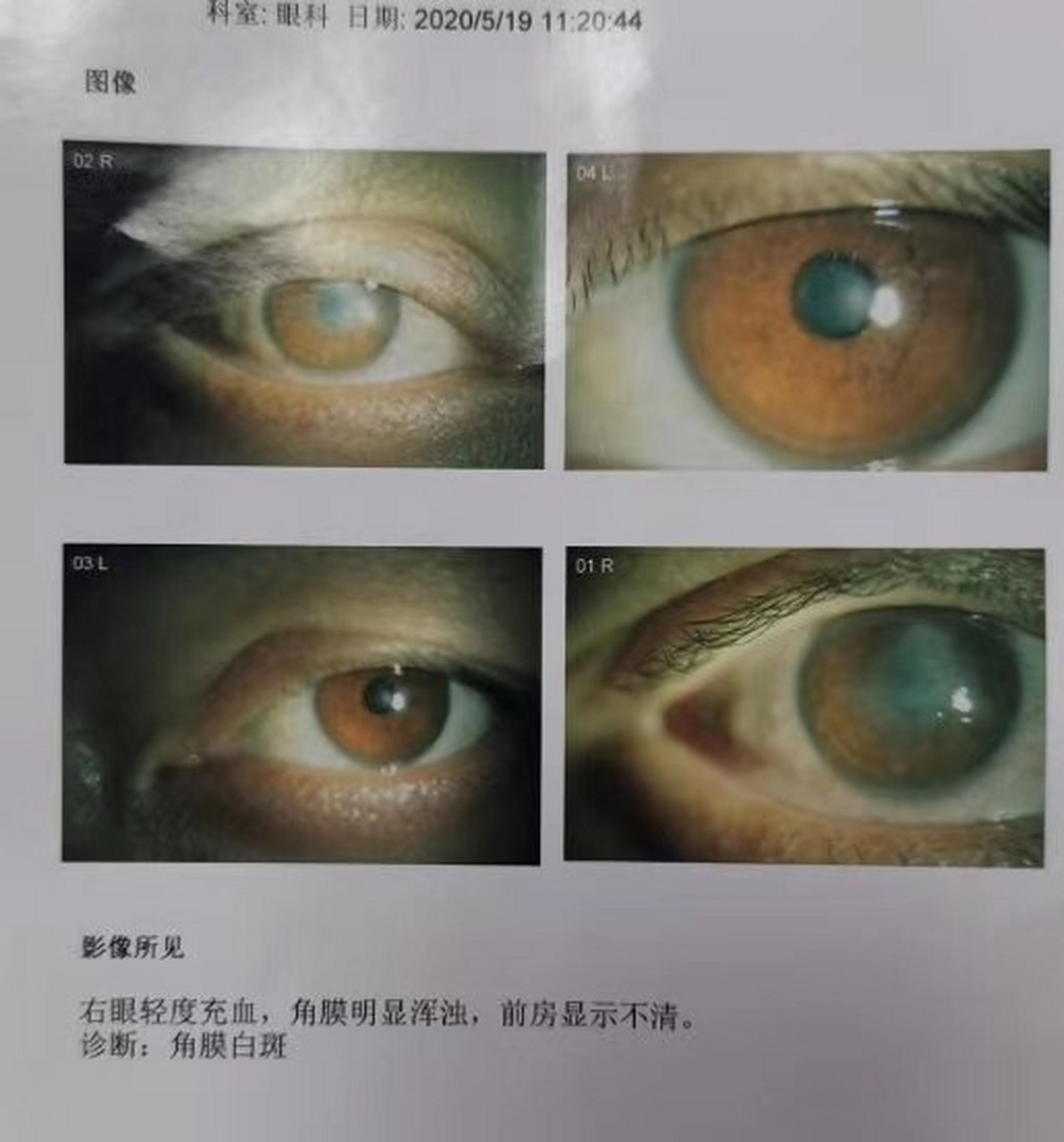 挑战成功! 又一世界难题:角膜白斑! 挑战成功94 信者得福