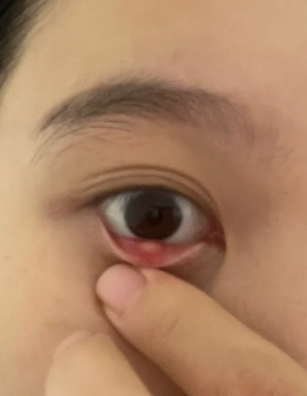 如金黄色葡萄球菌,溶血性链球菌等细菌侵入眼部,可能导致眼睑红肿