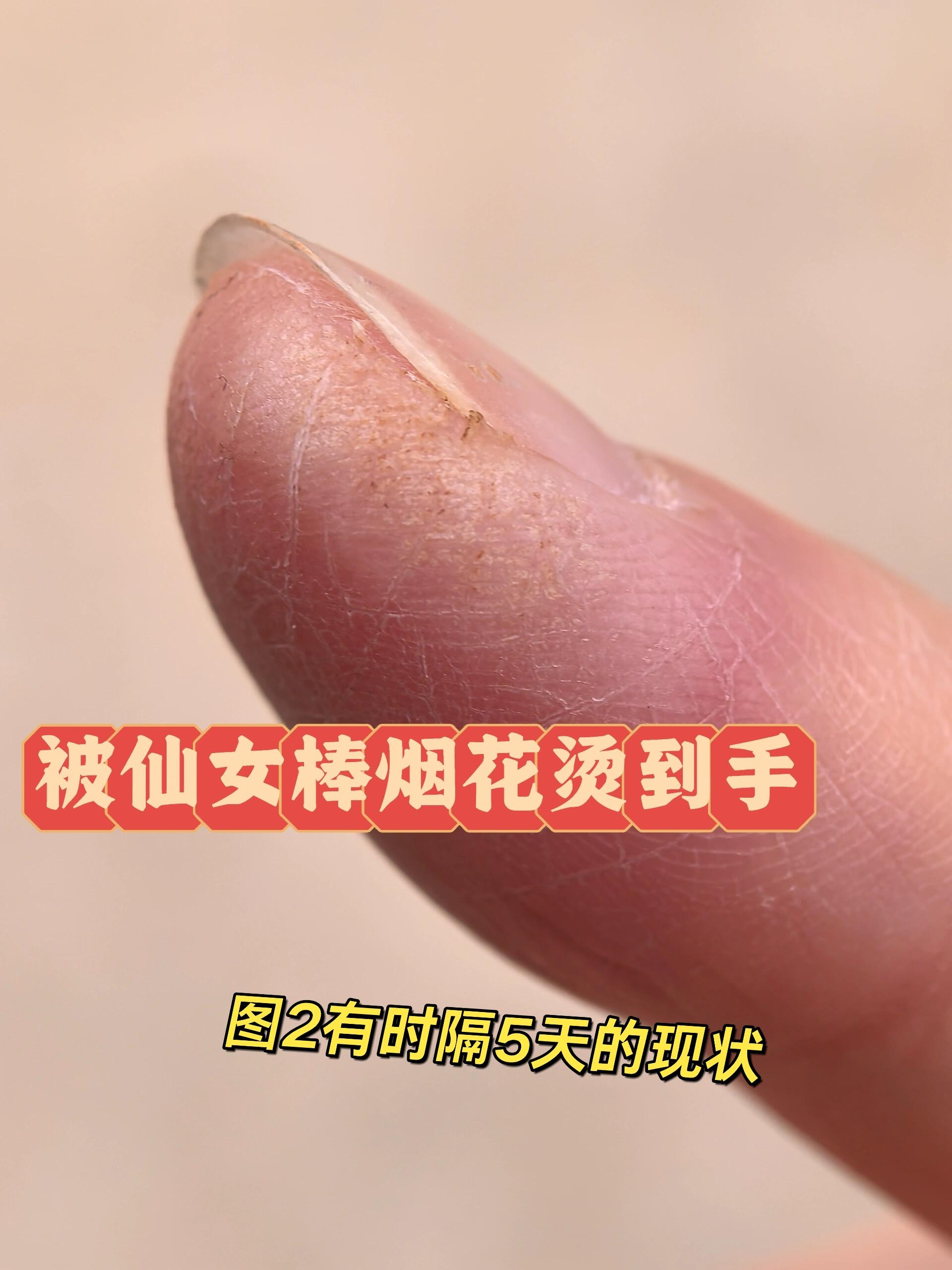 谁懂被烟花烫到大拇指6015 仙女棒质量不好,燃了一截再用打火机去