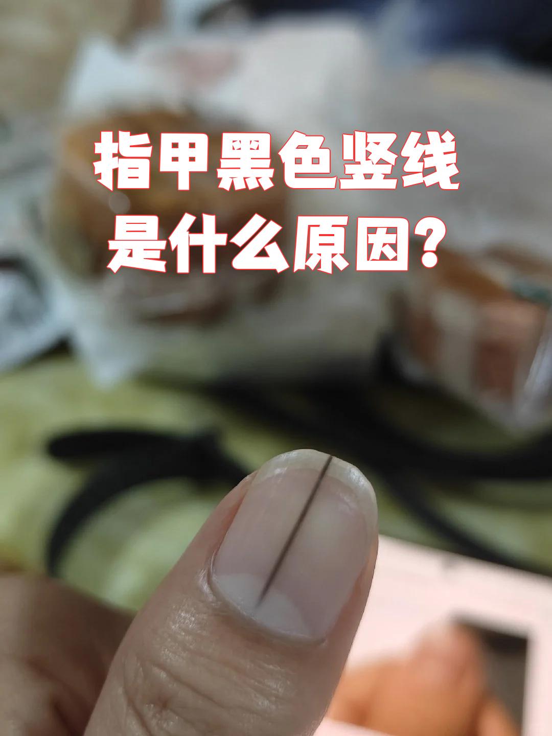 脚趾甲无缘无故黑了一块百科在线