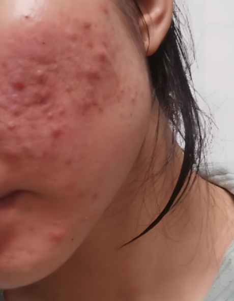 脸上痘痘红肿有硬块可能是痤疮,疖,接触性皮炎,表皮囊肿或水光针术