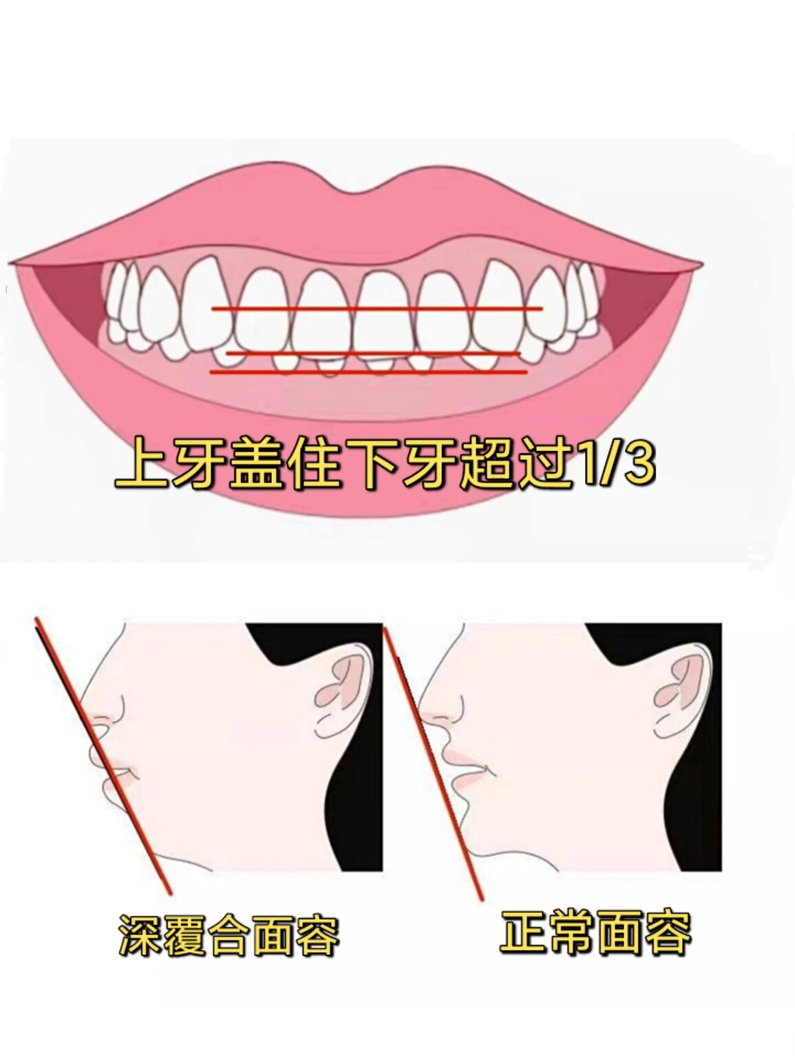 关于深覆合矫正 有些牙齿看似整齐