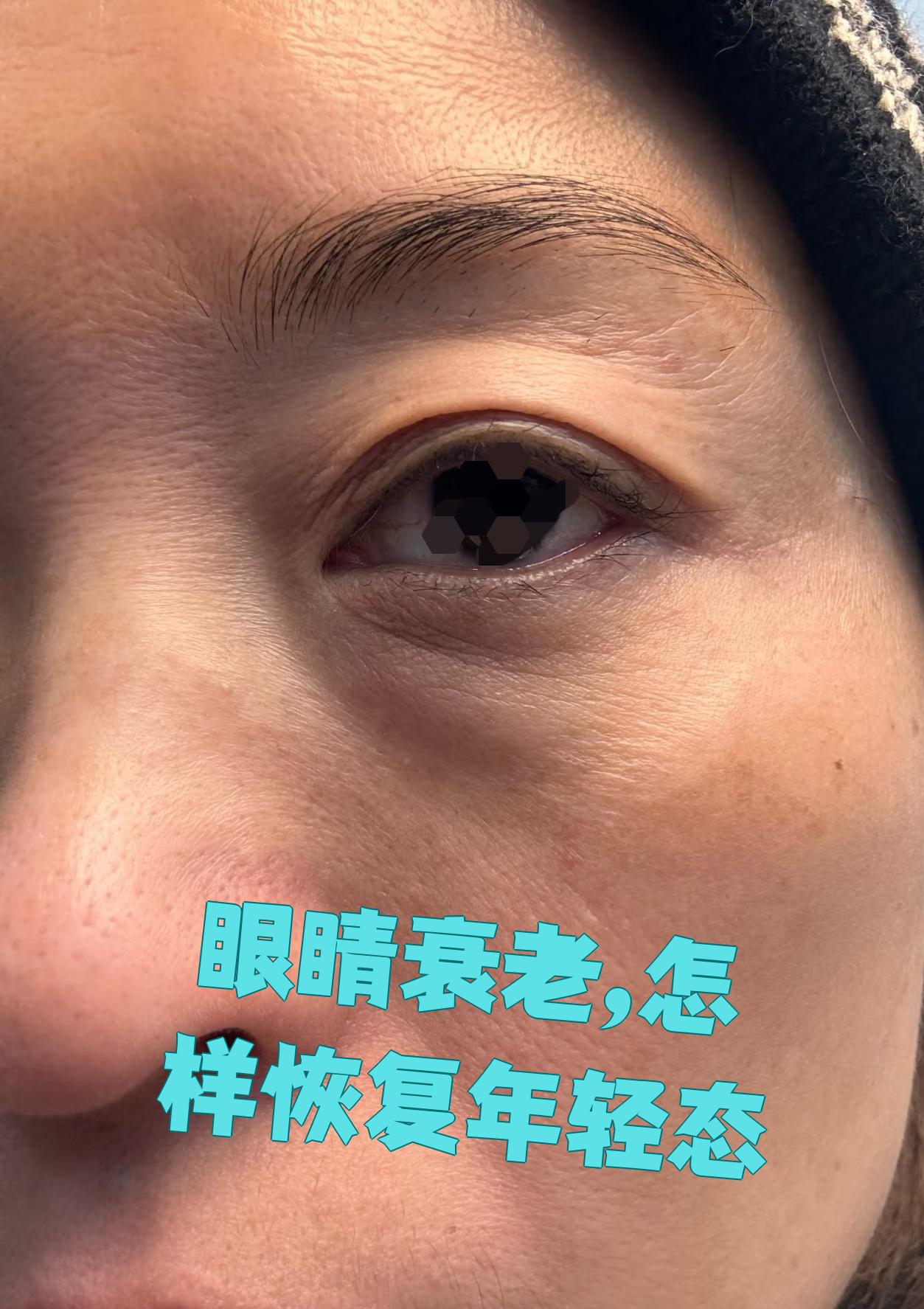 衰老是一个自然的生理过程,但通过一些方法可以帮助恢复或保持眼部的