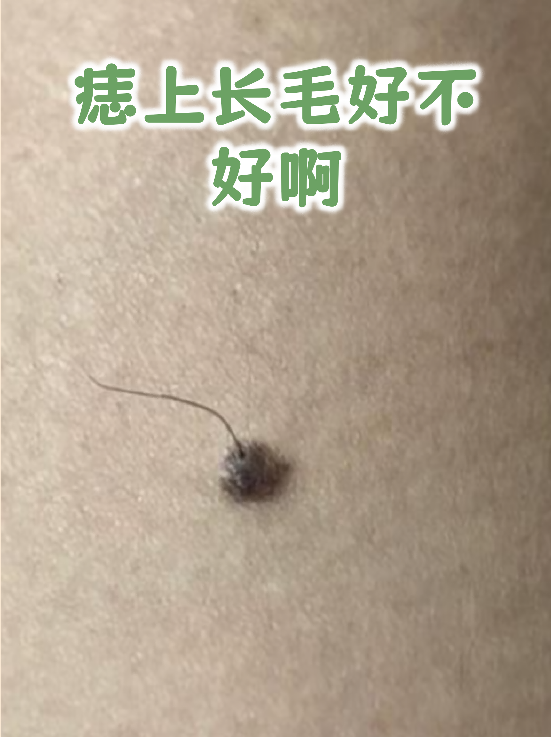很多人发现痣上长毛会感到困惑甚至担忧,其实这