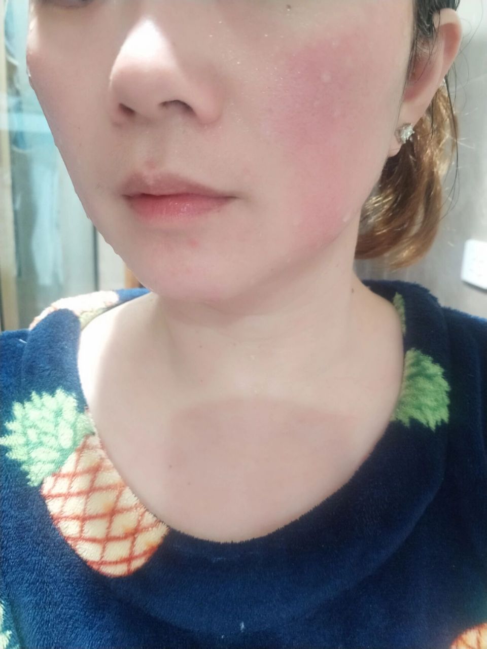 救救我这张发红发热还带烫和痒的脸