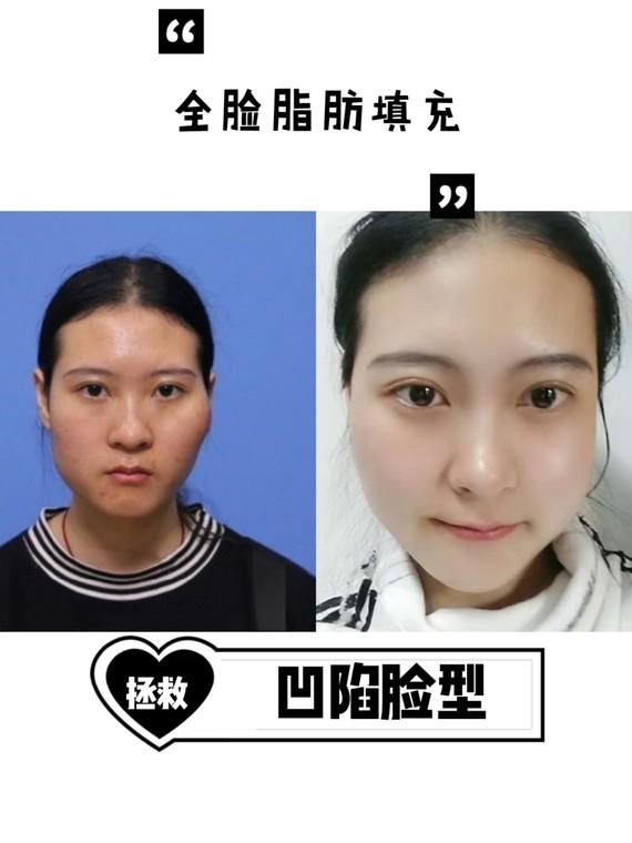自体脂肪填充全脸真实案例图片