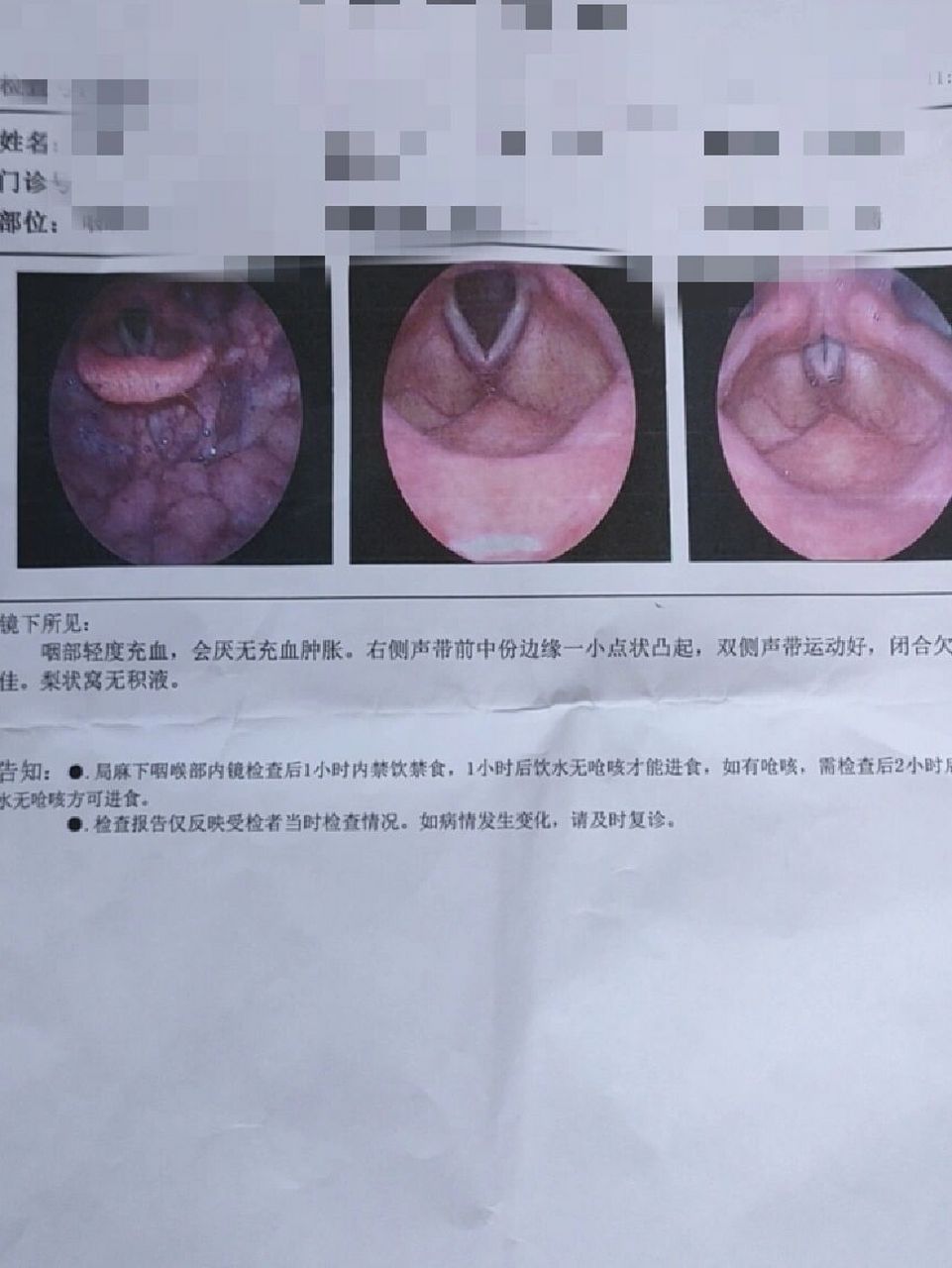 会厌炎喉镜图片图片