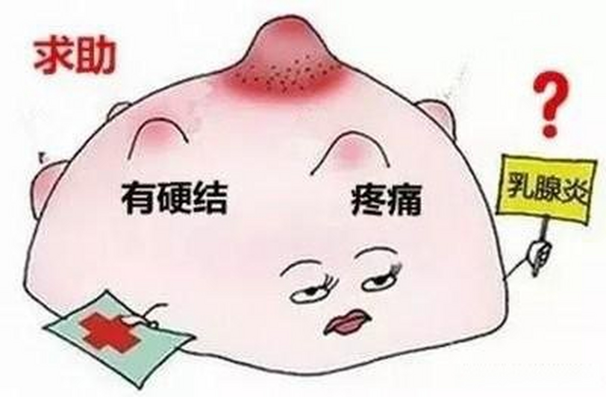 肉芽肿性乳腺炎,极易误诊为"乳腺癌" 患者无意中发现左侧乳腺肿块