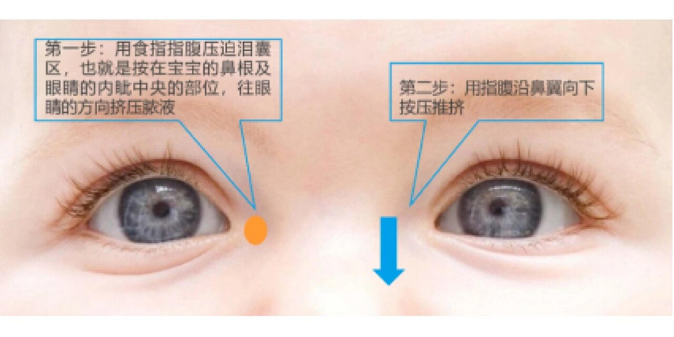 分享一张泪囊炎按摩图,需要的宝妈自己薅走