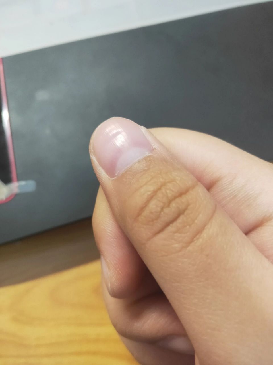 左右手大拇指指甲突然出现了横沟 右手大拇指指甲突然出现了一个像