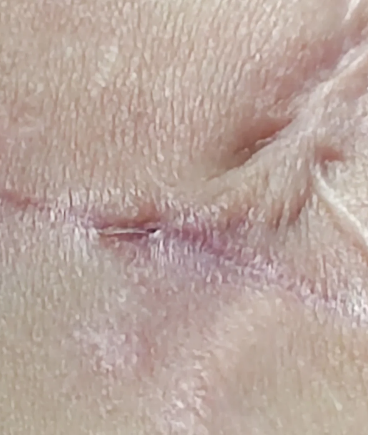 如果手术线长在肉里不拆除,结果要看用的是哪种手术线