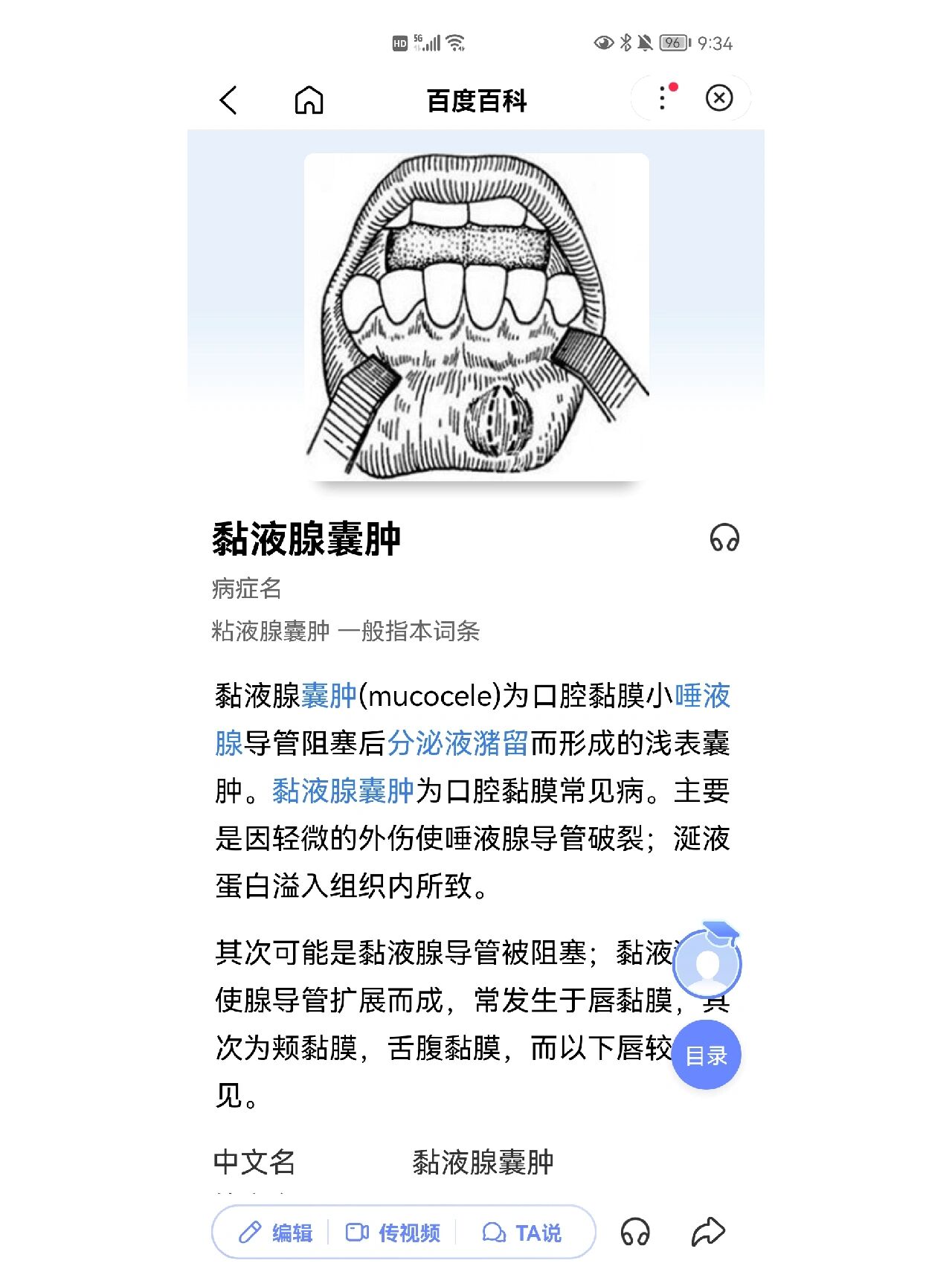 亲历粘液腺囊肿不手术自愈 孩子今年4月的时候下唇内部长了一个像水泡