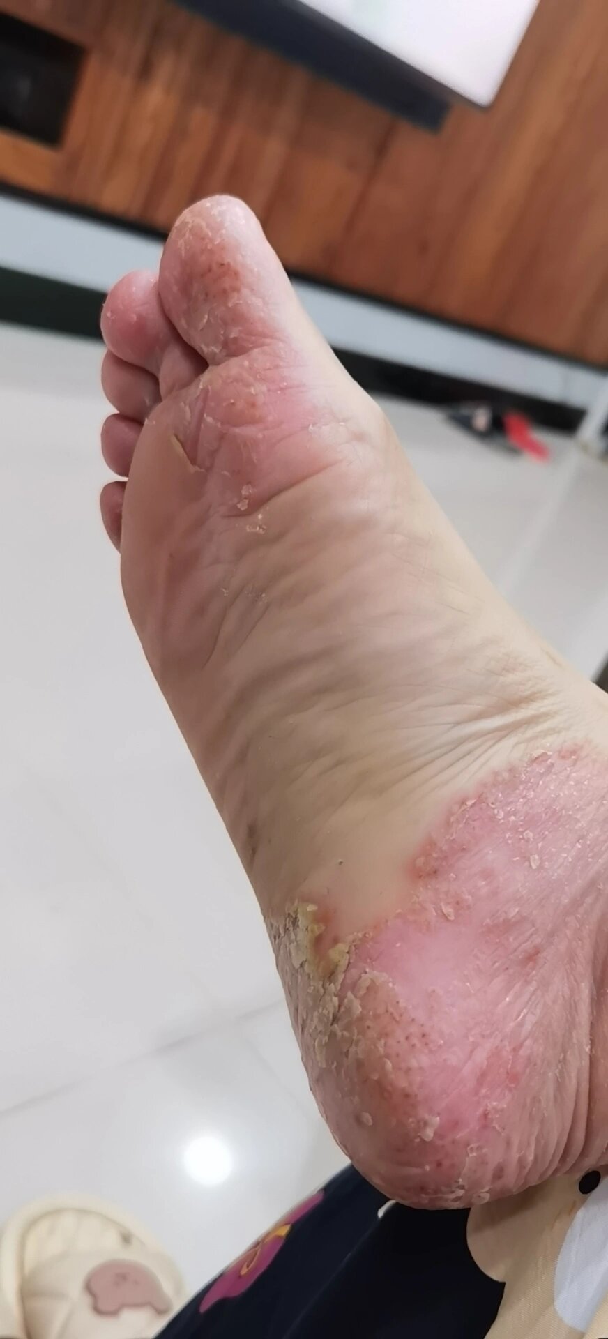 掌趾脓疱疹病的自愈2 这个病真的很顽固,刚开始只是出现在两只手掌