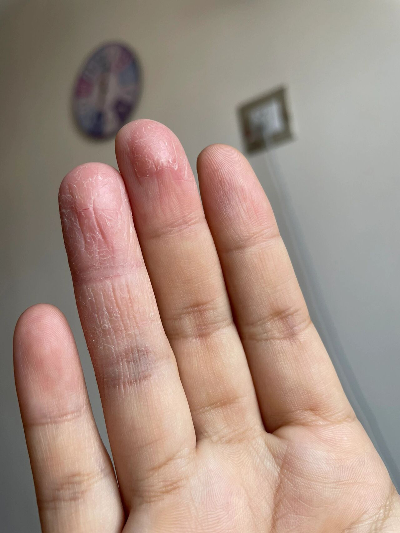 手指扒皮干裂 自从生完孩子后手指头不知道怎么回事就一直剥皮干裂