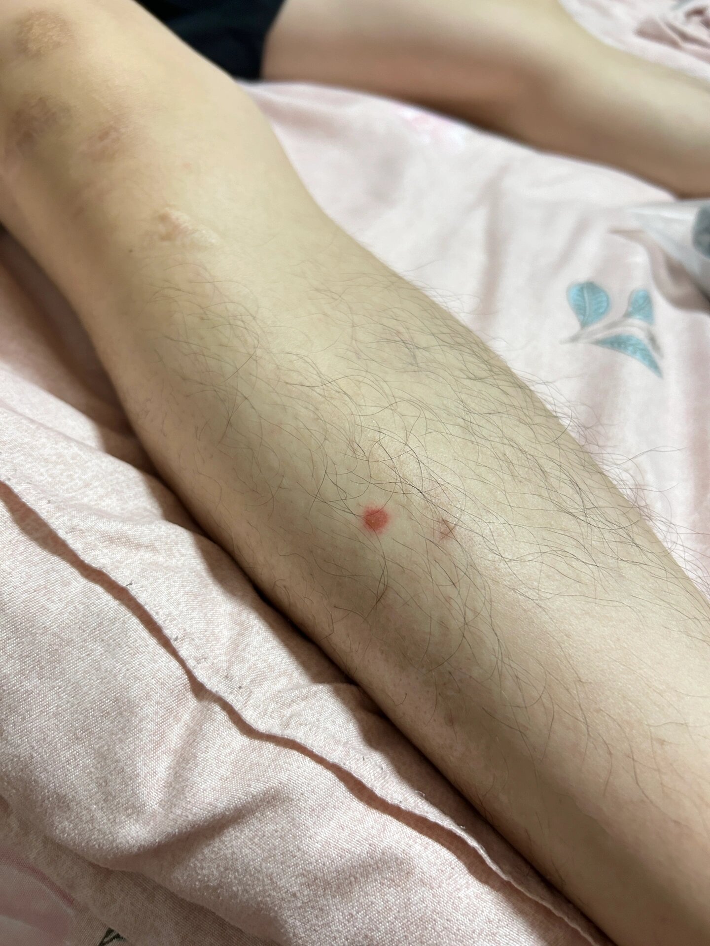 小腿上的红斑不痛不痒 老公腿上长了个红斑,不痛也不痒,这是咋回事呀?