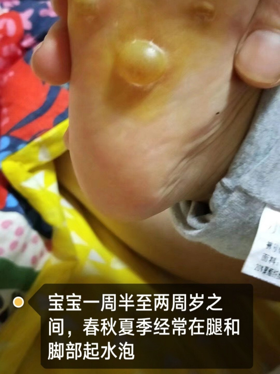 儿童腿部疱疹图片