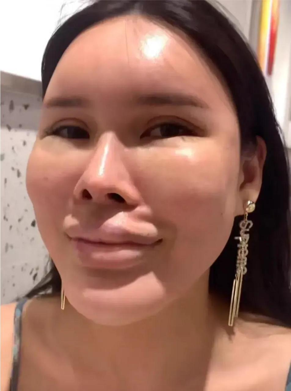 整容遭罪还变丑了!
