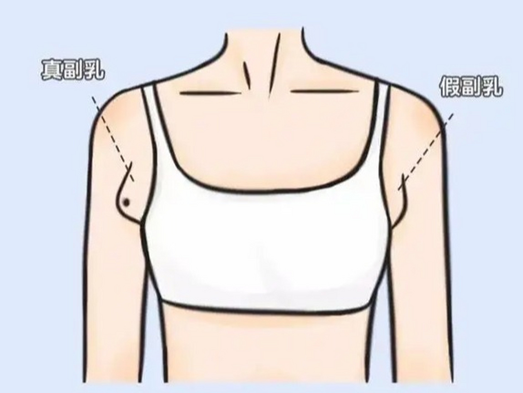 带你认识一下 "真" 副乳!