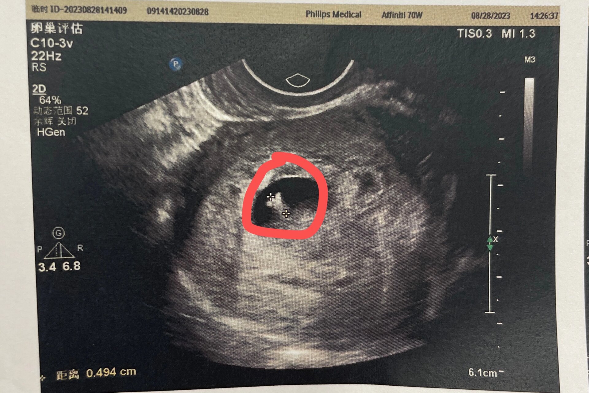 四十五天的孕囊