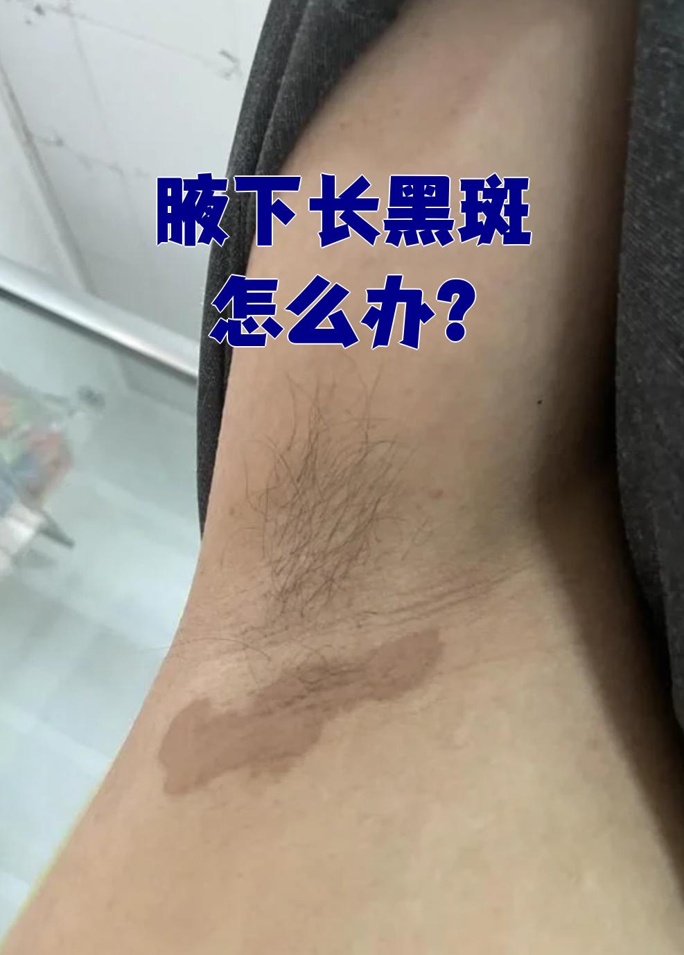 腋下出现黑斑最常见的原因是花斑癣和黑棘皮病