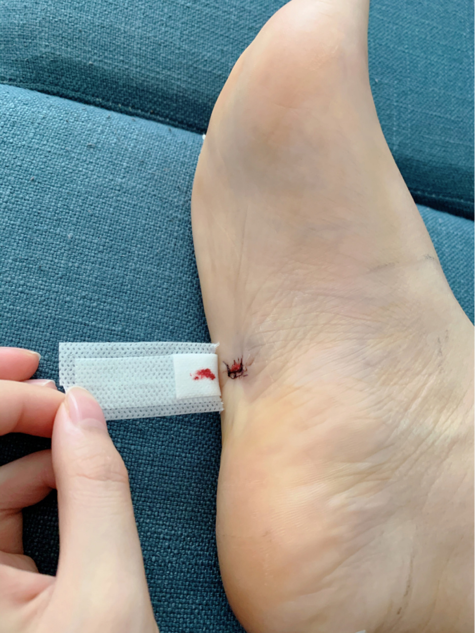 [大笑]足底痣五颗切除手术第五天～ 我脚底有一个很大的痣在正中央