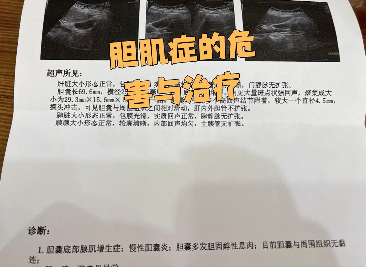 胆囊腺肌症是一种良性胆囊疾病,主要表现为胆囊