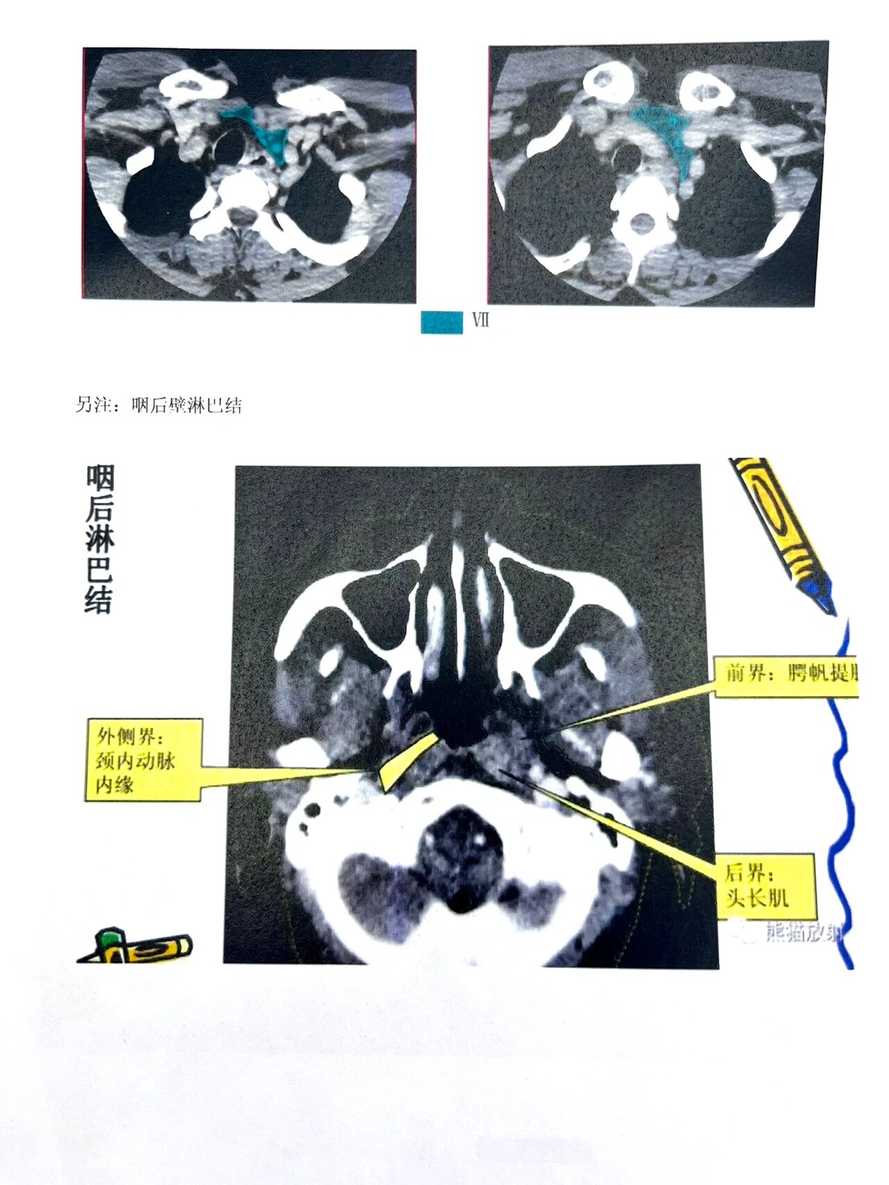 环状软骨ct解剖图图片