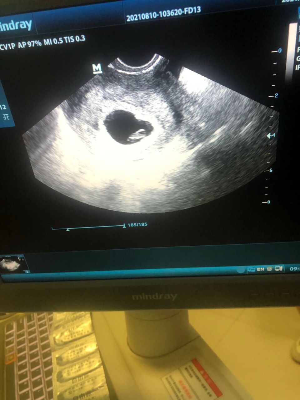 8*16 今天阴超孕囊2.1*16.