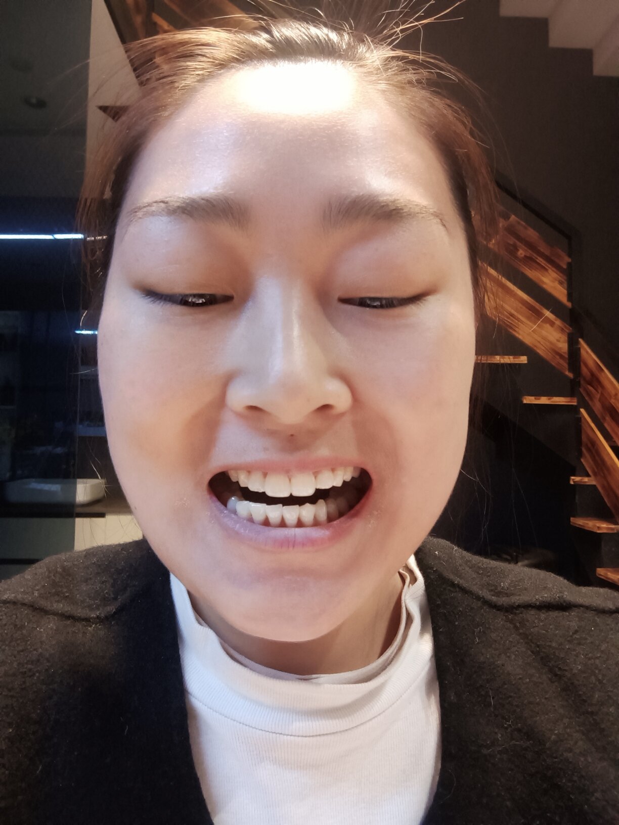 颞下颌关节紊乱综合征 病症:大小脸,张嘴时歪脸,有咯吱声,伴有左耳