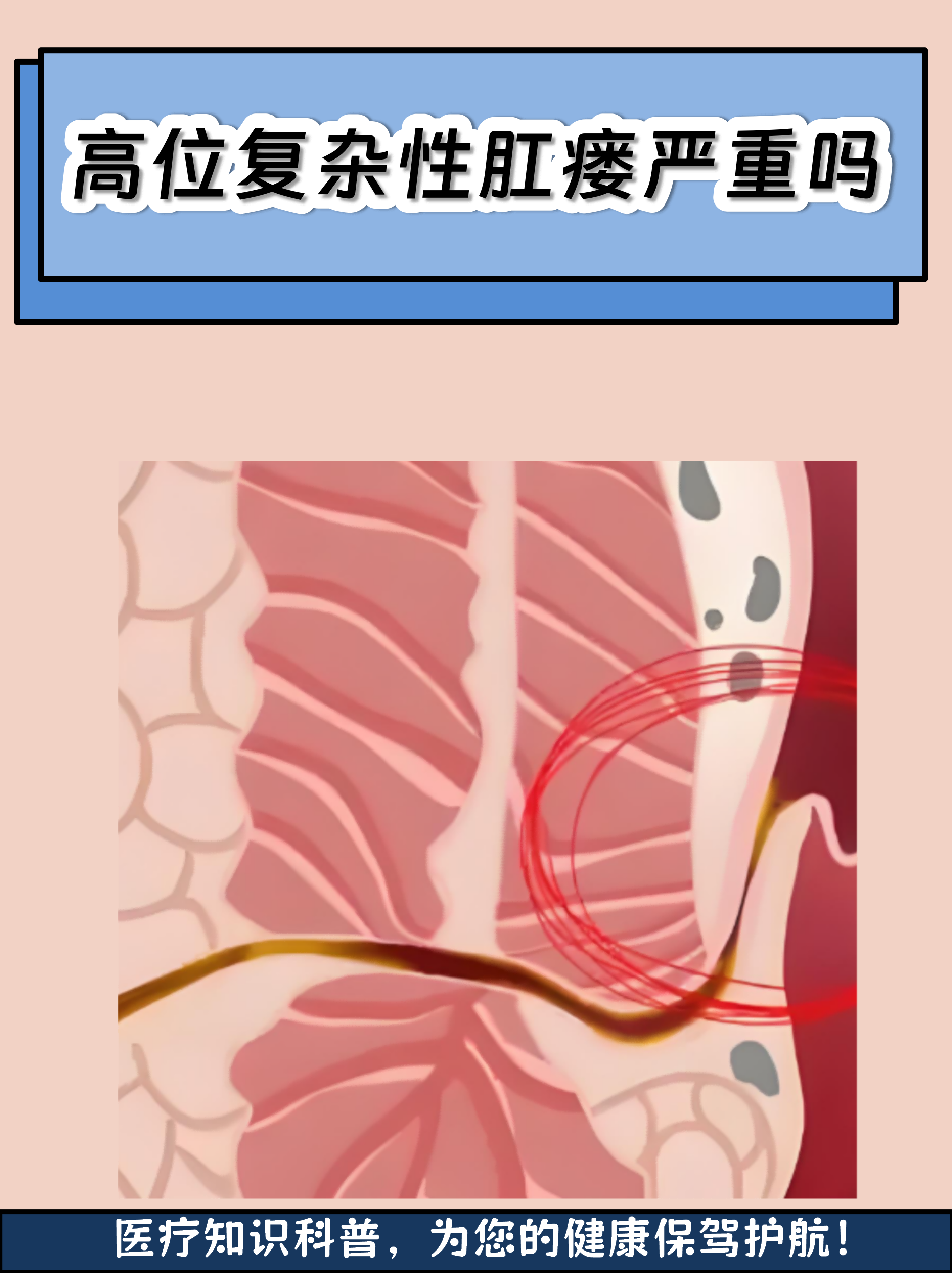 高位复杂性肛瘘严重吗