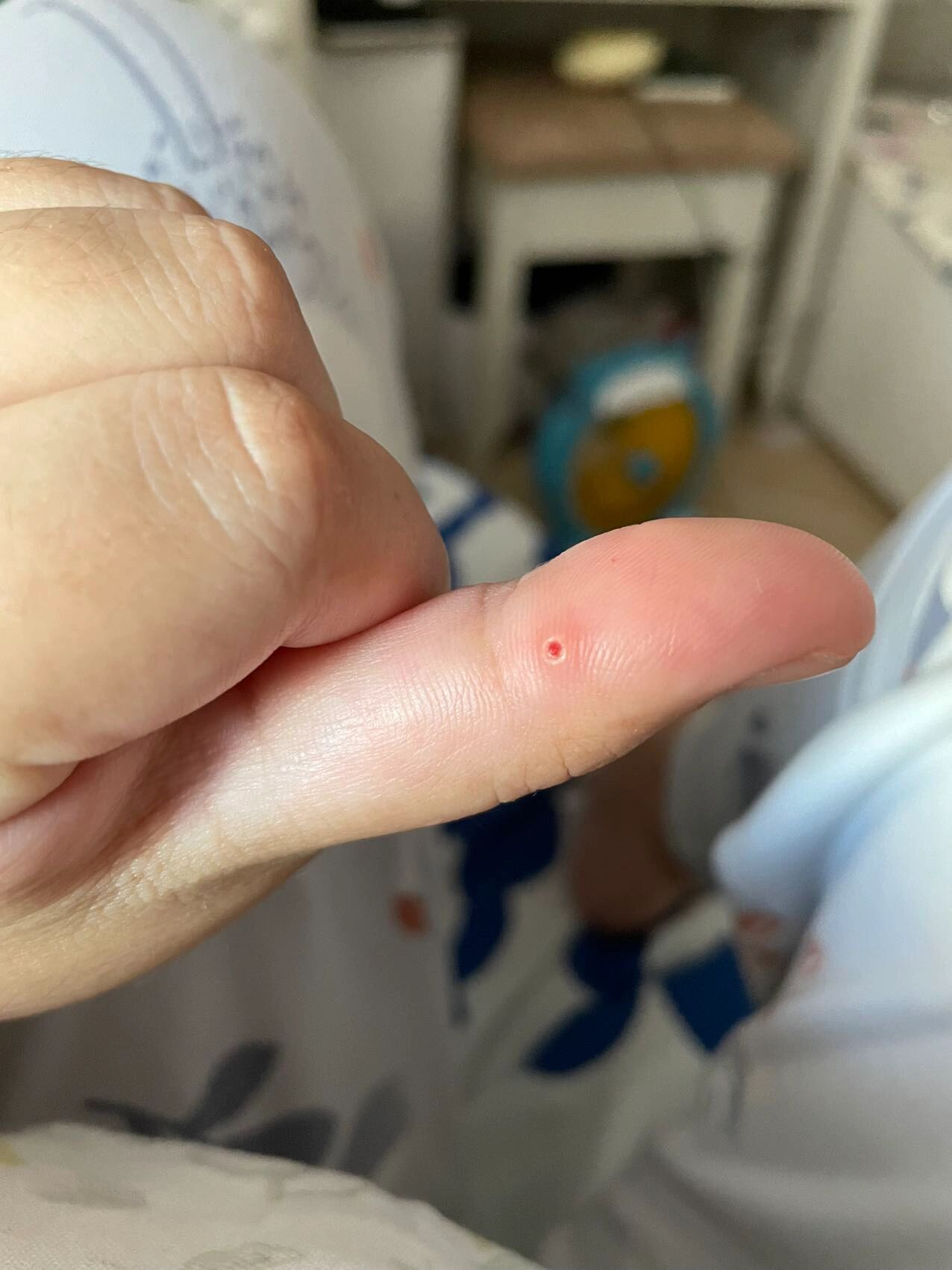 不懂就问,这是啥 生完孩子后发现大拇指有个红点点,刚开始也不在意