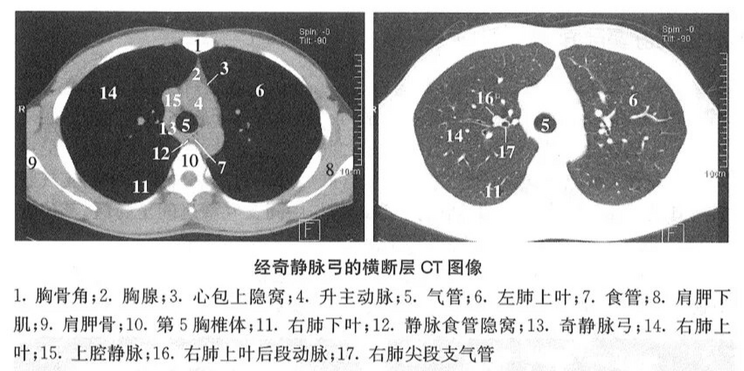 奇静脉弓下缘图片