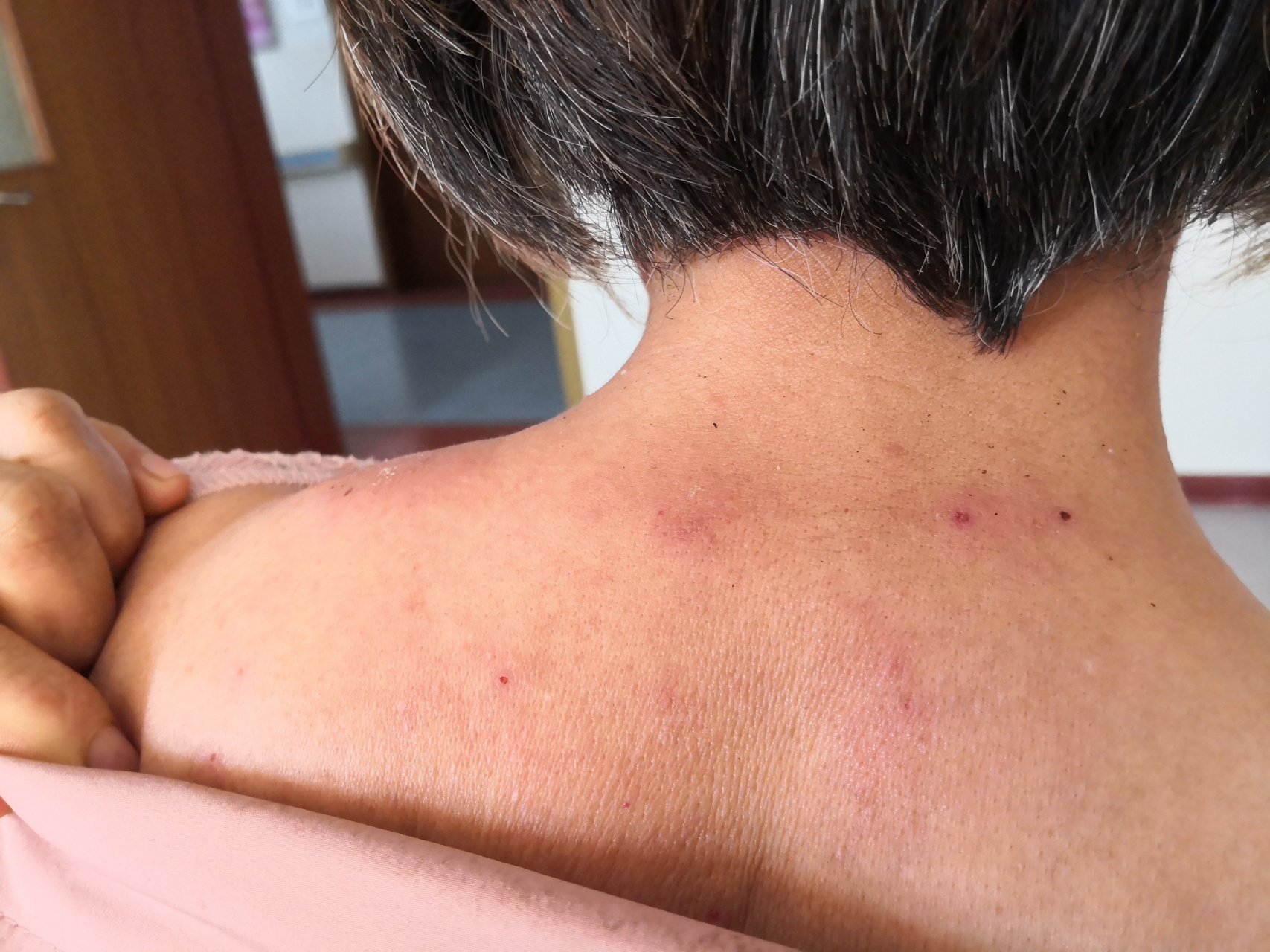 前胸后背四肢散发的片状红斑风团症状#过敏##荨麻疹# 荨麻疹症状.