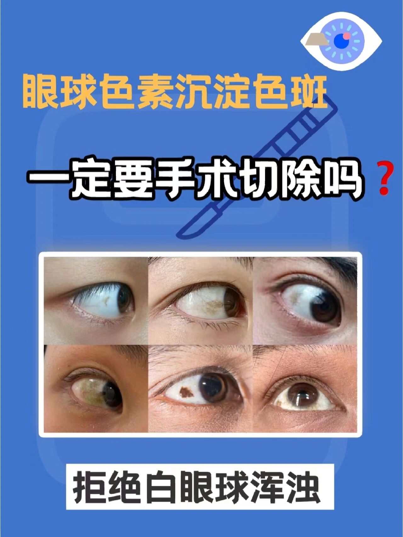 手术切除色素斑,是指将白色眼球上的色素沉淀和眼白色素痣在显微镜下