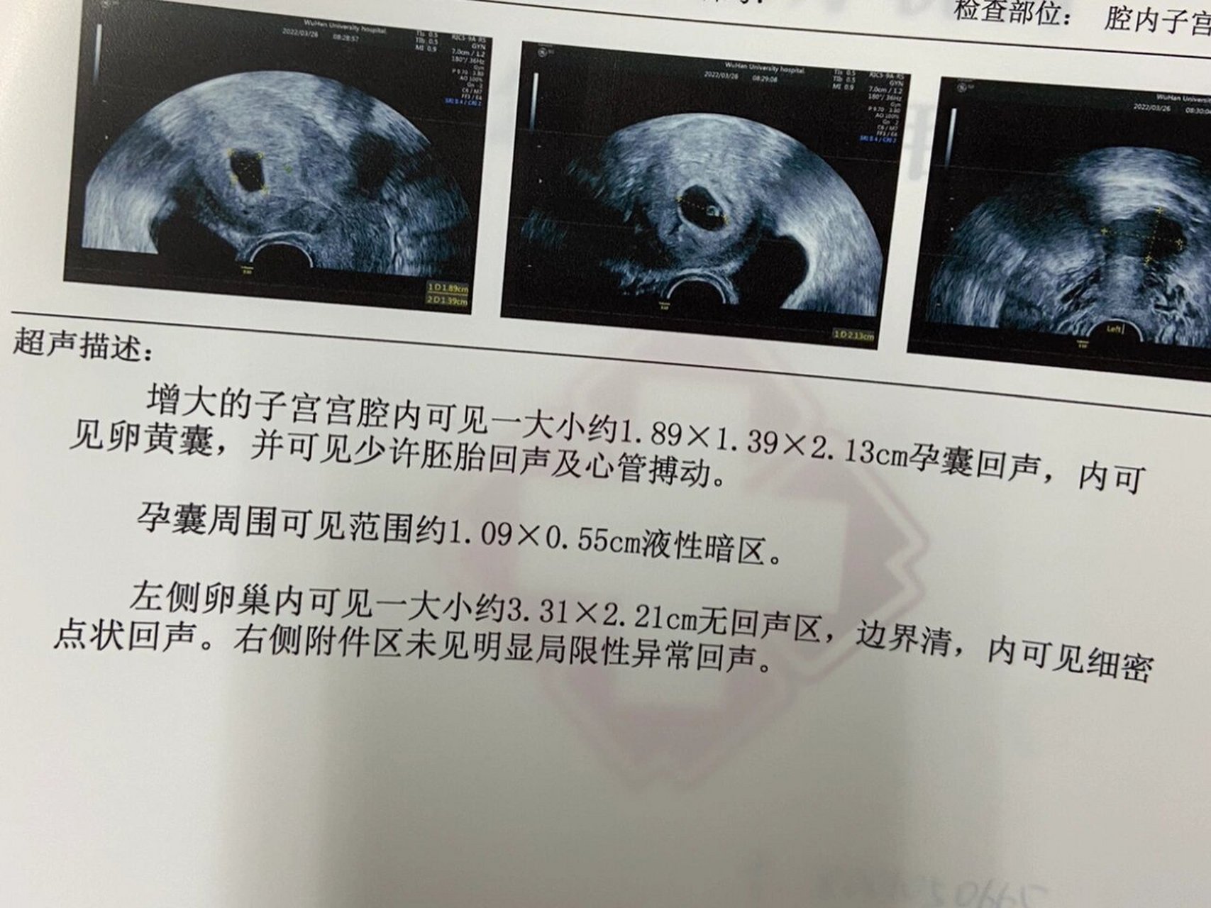 5周啥没有,6周啥都有 5周在省妇幼做的阴超,只有孕囊,当时医生说的