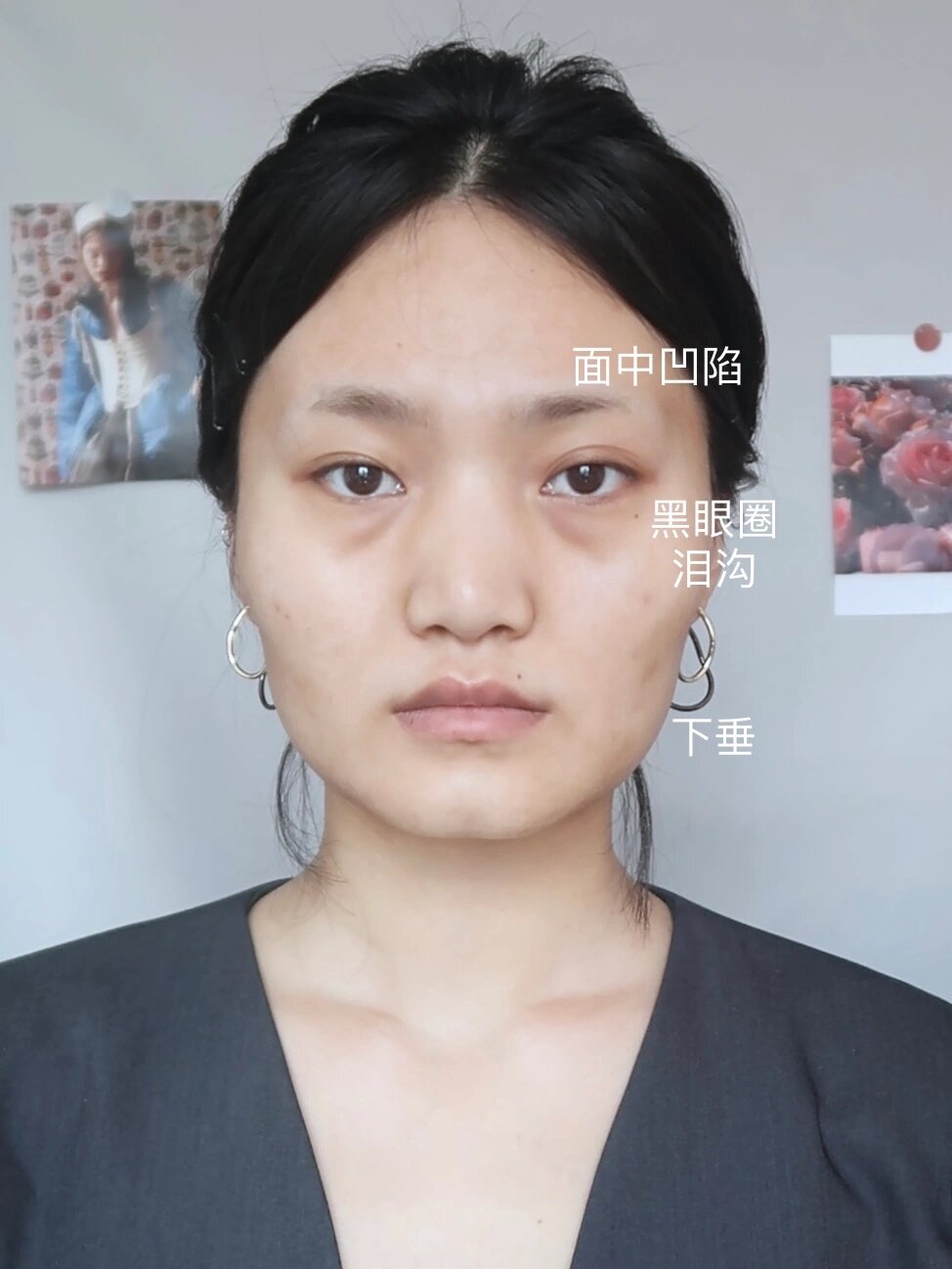 凹陷脸一定要试试热玛吉底妆大法!立减十岁!