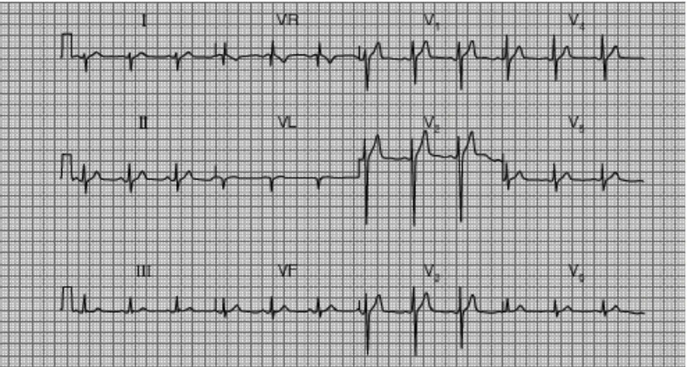 窦性心动过速 窦性心动过速是指成年人窦性心率超过100次/分,常见于