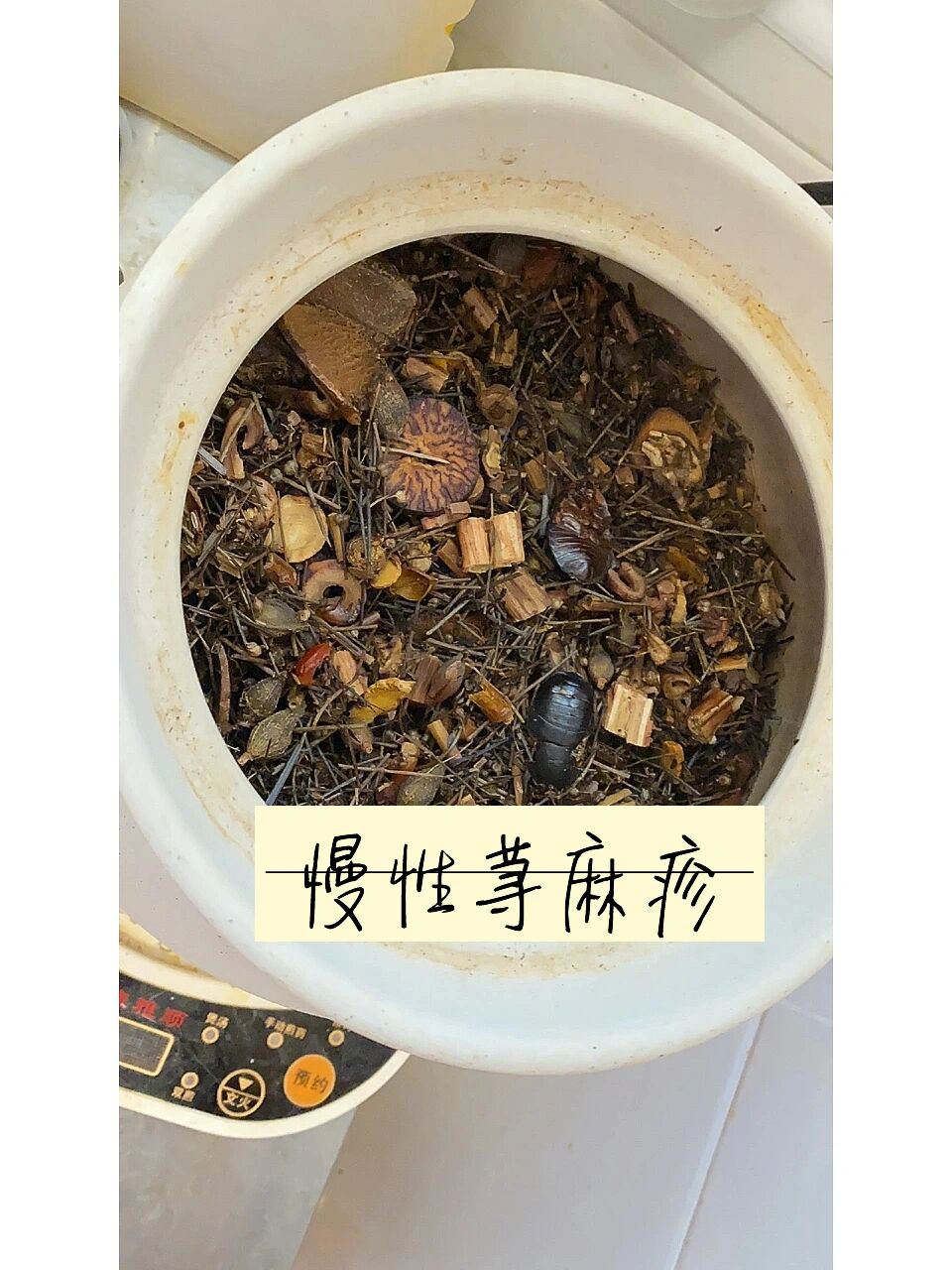 慢性荨麻疹每日续命药💊