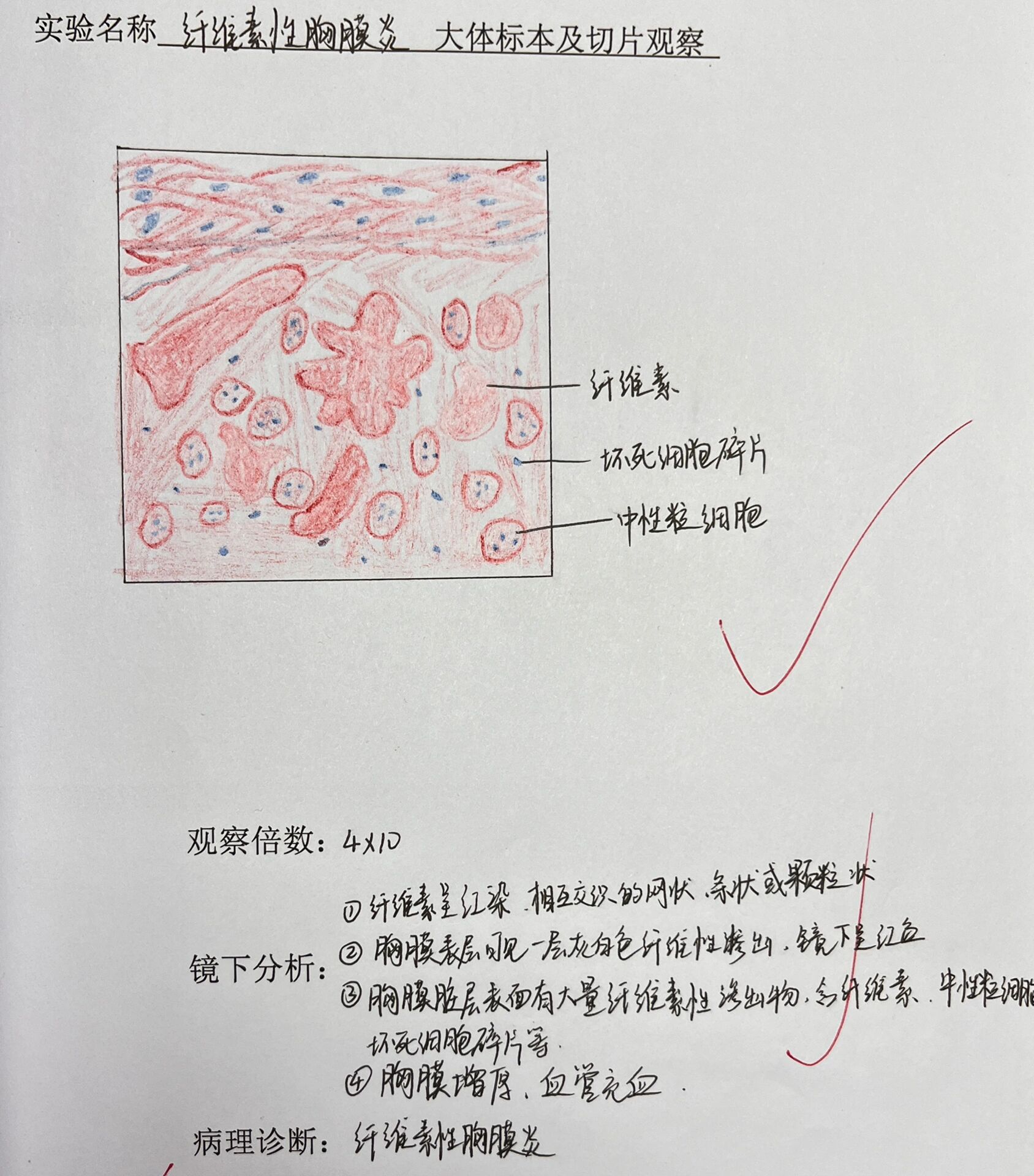 纤维素性胸膜炎 病理