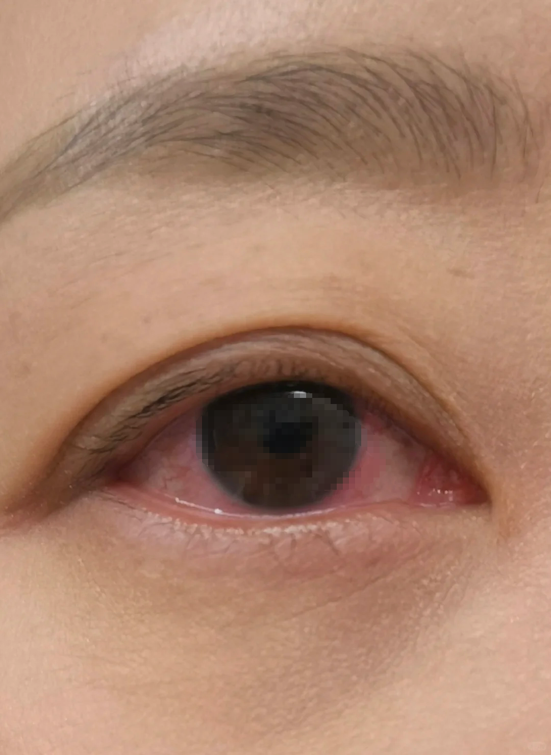 第一种是虹膜睫状体炎