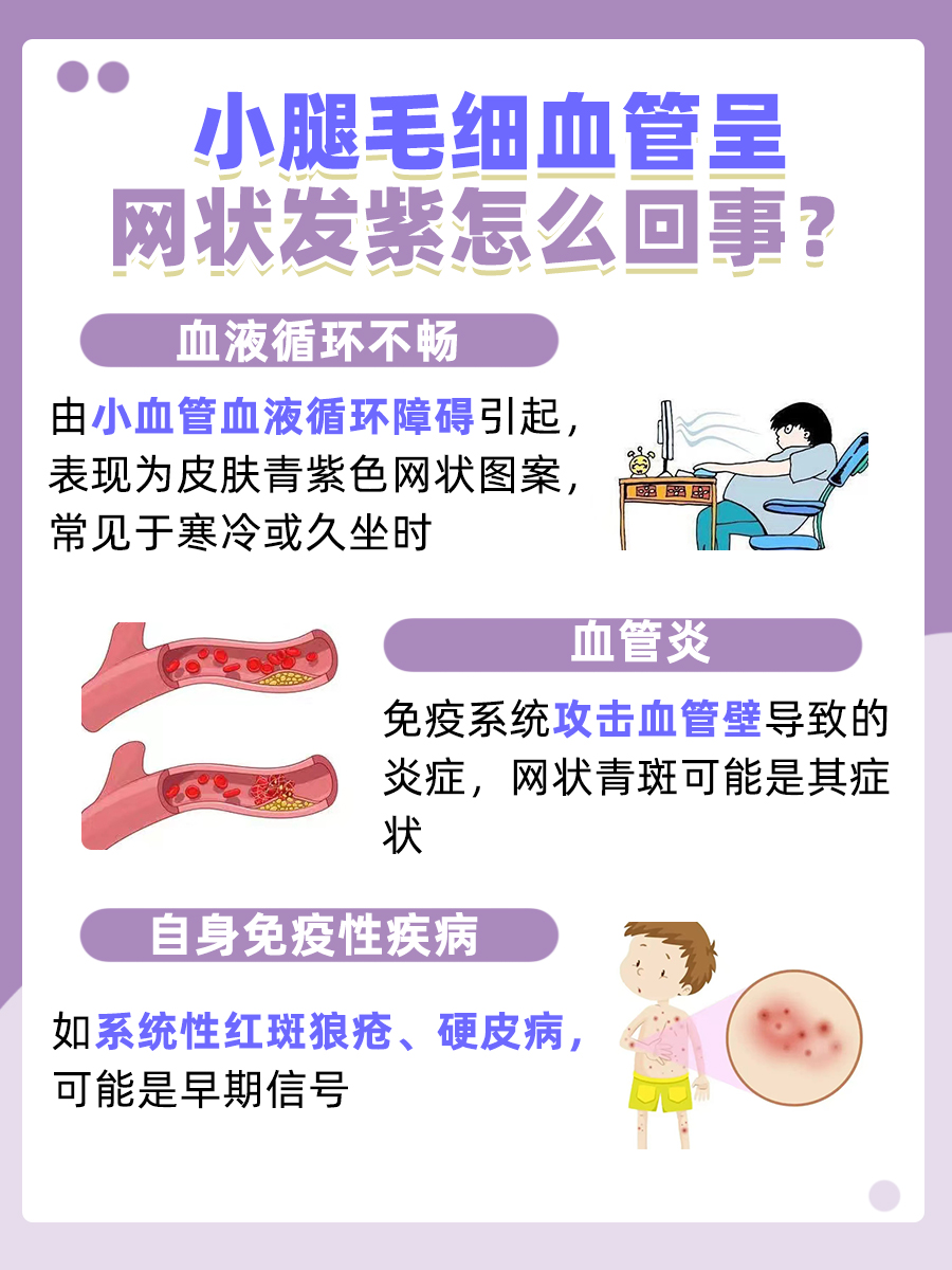 小腿毛细血管呈网状发紫,这是一种较为常见的皮肤现象,其特征是皮肤