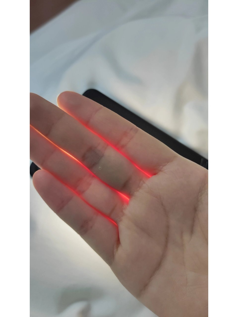 这是手指里面的血管爆了吗 怎么可以这么好笑玩闹过程中手拍到了手机