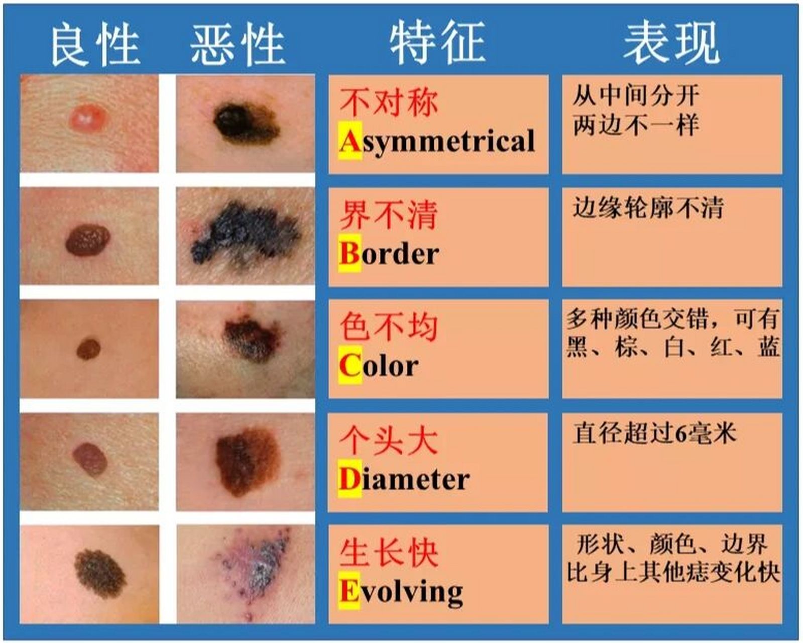 一分钟自查黑色素瘤 我不是医生!