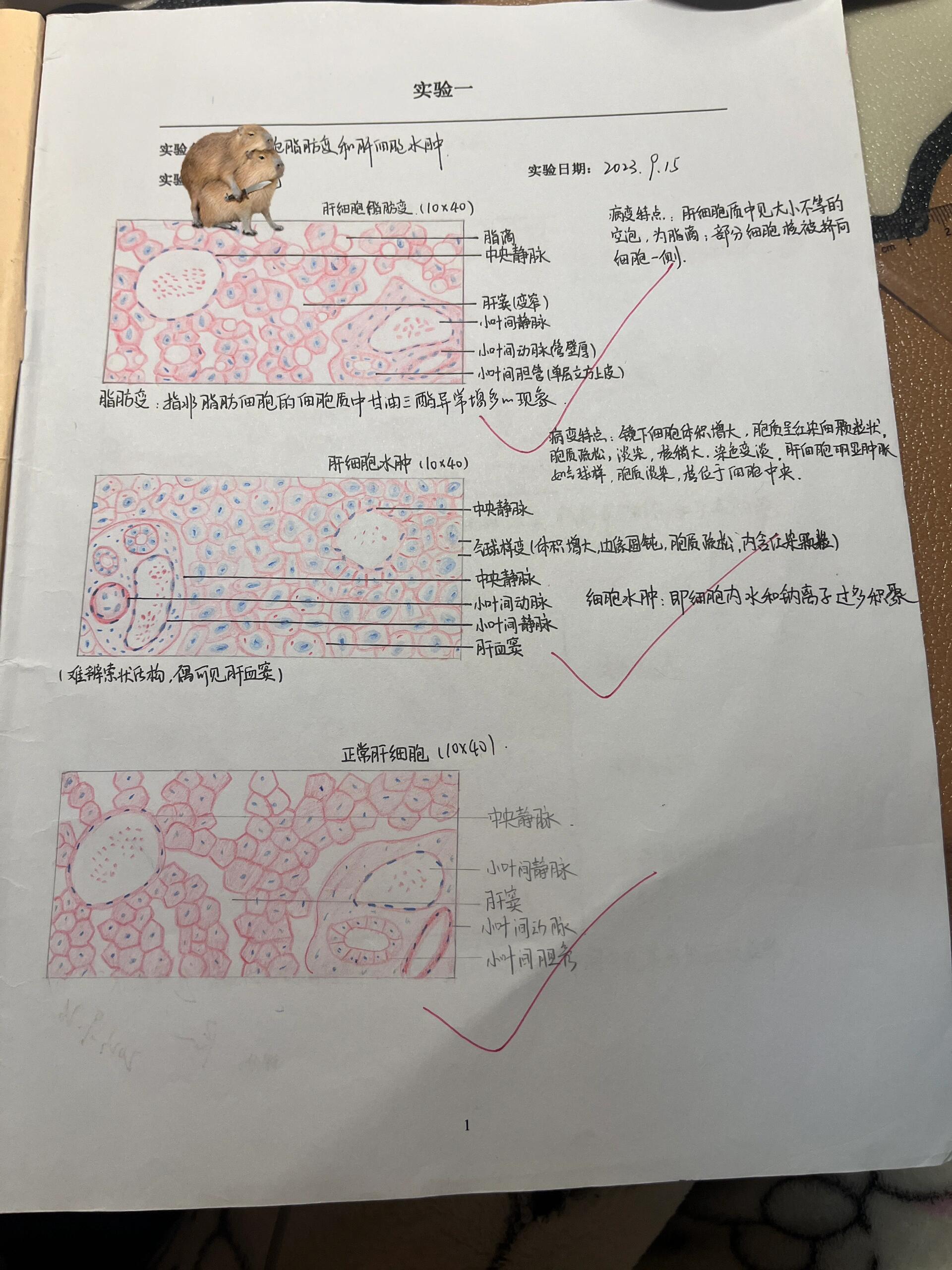 护理学肝细胞红蓝铅笔图 肝细胞脂肪变 肝细胞水肿 正常肝细胞