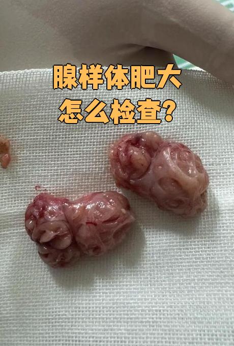 腺样体肥大主要通过口咽部检查,前鼻镜检查,鼻咽镜检查,鼻内窥镜