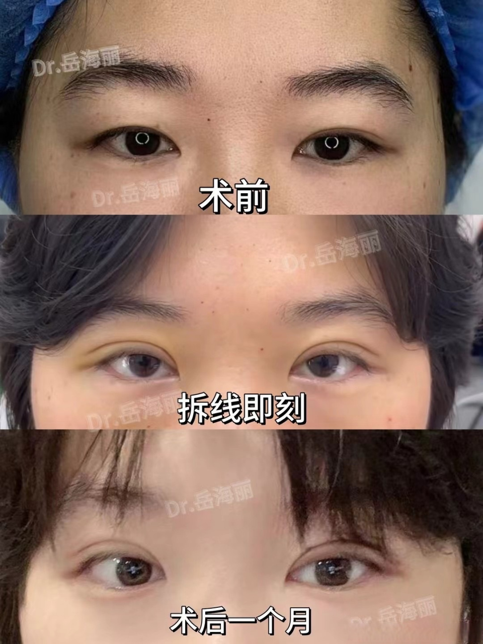 这是我给小姑子做的全切双眼皮,去皮祛脂,术后一个月的恢复情况,是不