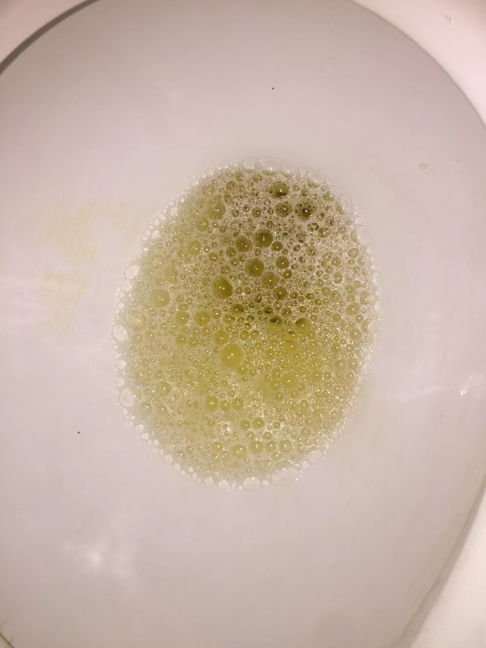 泡沫尿的图片 正常图片