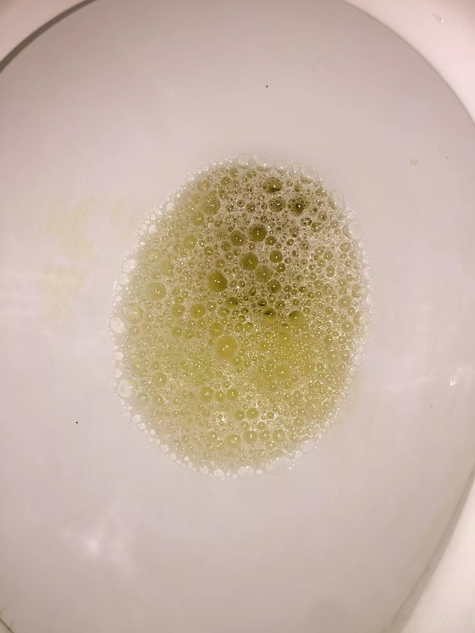 40岁的余女士,以浮肿,腰痛,泡沫尿2年余为主诉来诊.